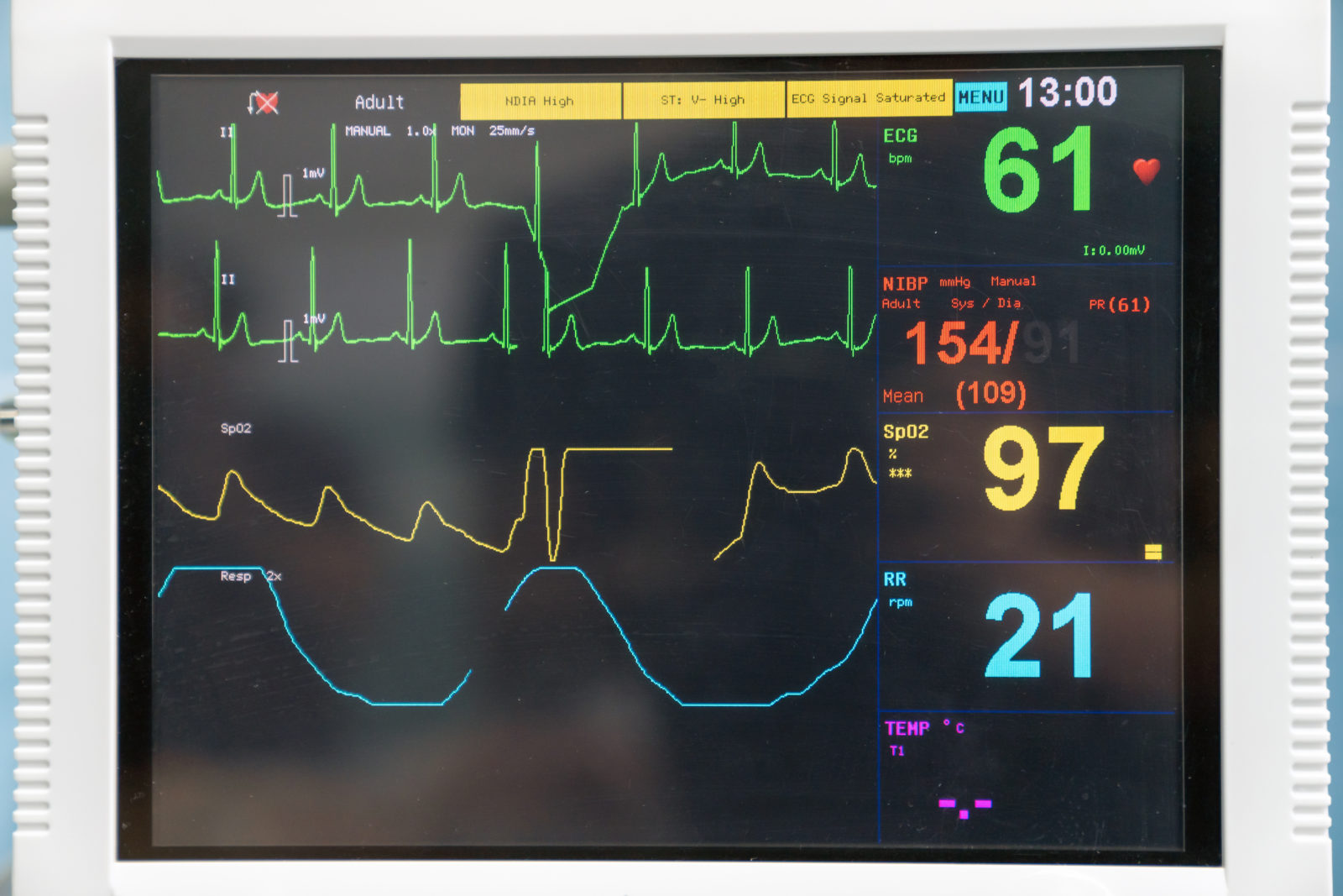EKG as monitoring